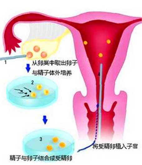 处女代孕过程_46岁借卵子生子前子宫怎样调理8种