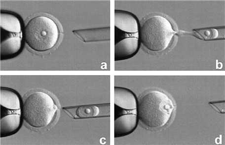 先天性卵巢发育不全综合征可以怀孕吗-一代试管