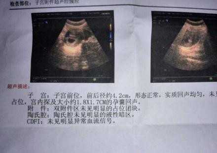上海传承助孕的专栏上海输卵管自己检查小窍门